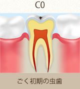 ごく初期の虫歯