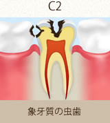 象牙質の虫歯