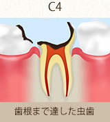 歯根まで達した虫歯