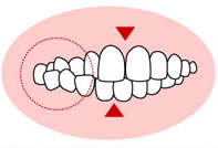 交叉咬合（こうさこうごう）